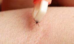 Россиянам рассказали о неочевидных симптомах укуса клеща